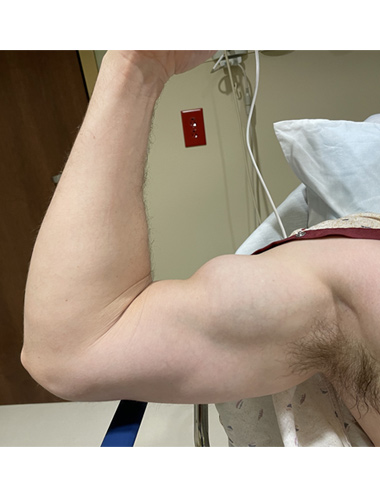 Biceps Tendon Repair