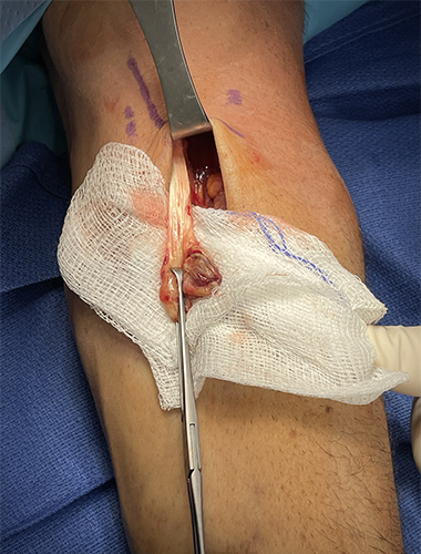 Biceps Tendon Repair
