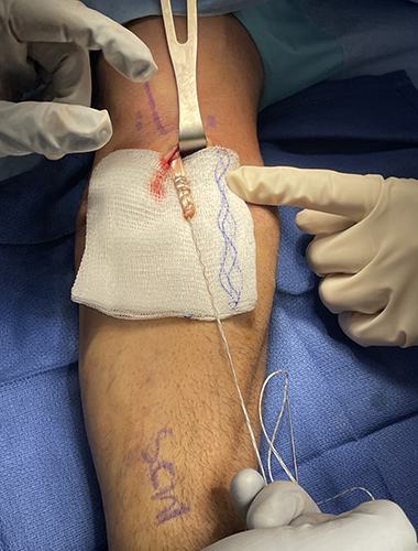Biceps Tendon Repair