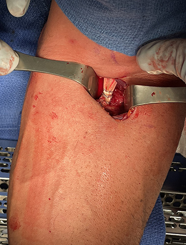 Biceps Tendon Repair