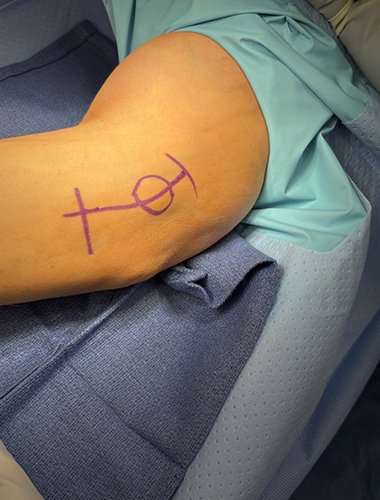 Elbow Flexor Tendon Tears