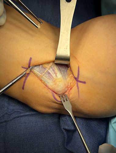 Elbow Flexor Tendon Tears