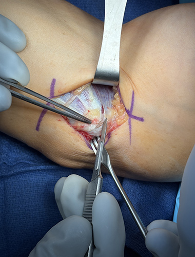 Elbow Flexor Tendon Tears