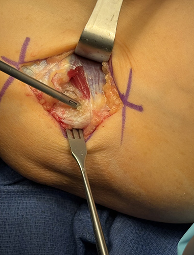 Elbow Flexor Tendon Tears