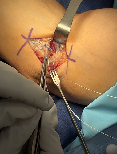 Elbow Flexor Tendon Tears