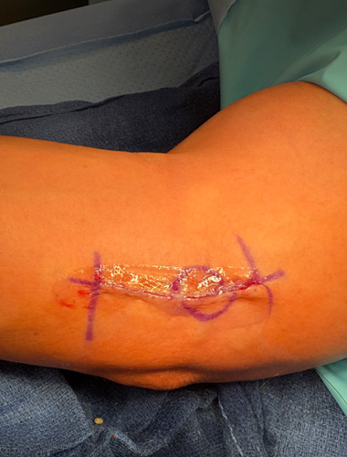 Elbow Flexor Tendon Tears