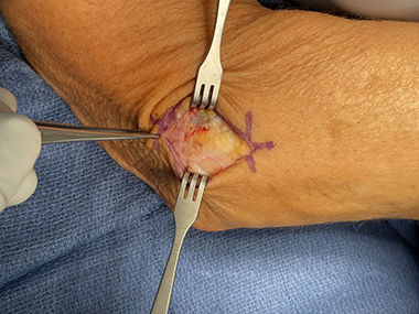 Elbow Repair