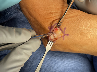 Elbow Repair
