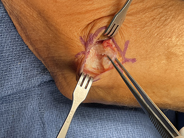 Elbow Repair