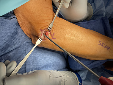 Elbow Repair