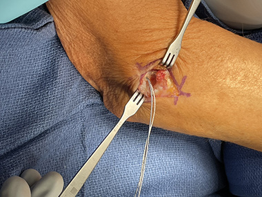 Elbow Repair