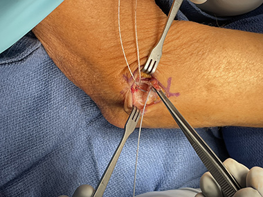 Elbow Repair