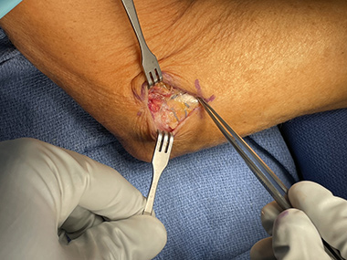 Elbow Repair