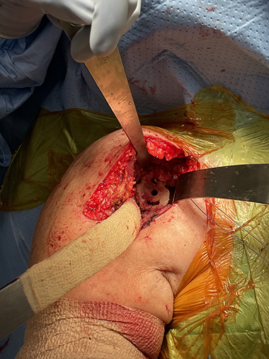 Anatomic Shoulder Replacement