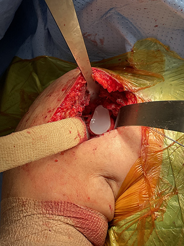 Anatomic Shoulder Replacement