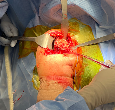 Anatomic Shoulder Replacement