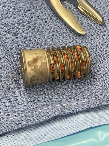 Anatomic Shoulder Replacement