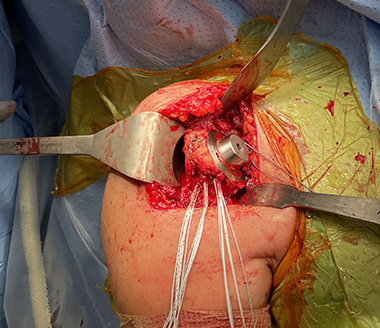 Anatomic Shoulder Replacement