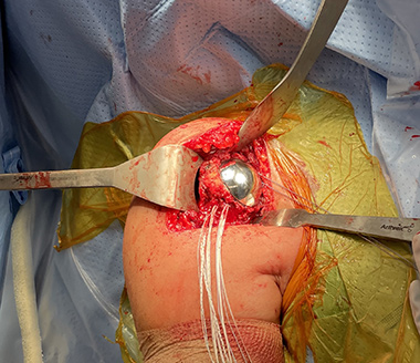Anatomic Shoulder Replacement