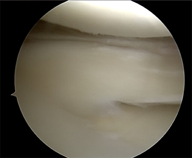 Lateral Meniscus Repair