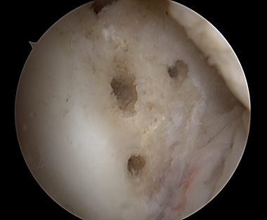 Lateral Meniscus Repair