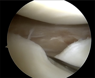 Lateral Meniscus Repair