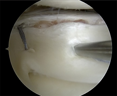 Lateral Meniscus Repair