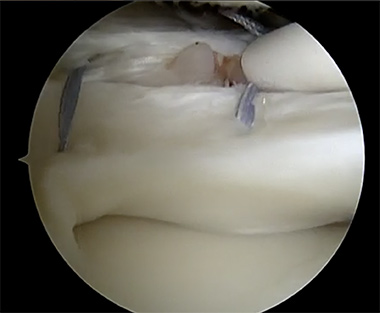 Lateral Meniscus Repair