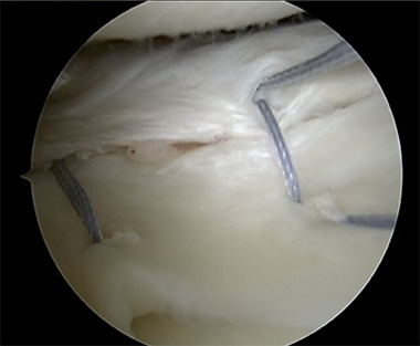 Lateral Meniscus Repair