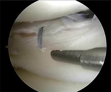Lateral Meniscus Repair