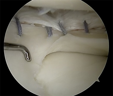 Lateral Meniscus Repair