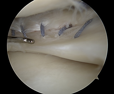 Lateral Meniscus Repair
