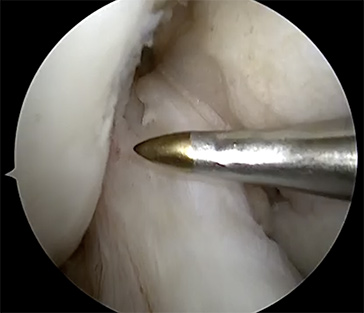 Lateral Meniscus Repair