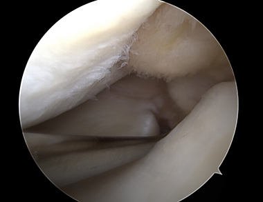 Meniscus Root Repair
