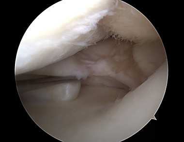 Meniscus Root Repair