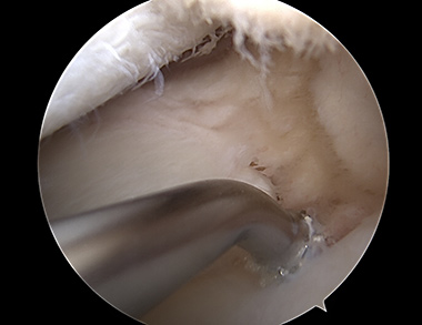 Meniscus Root Repair