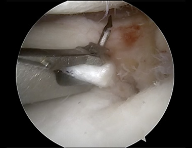 Meniscus Root Repair