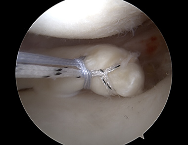 Meniscus Root Repair