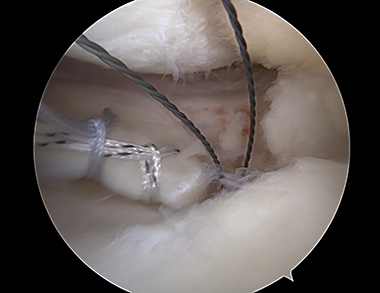 Meniscus Root Repair