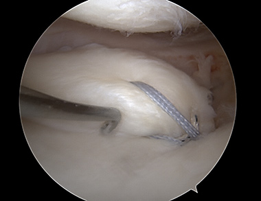 Meniscus Root Repair