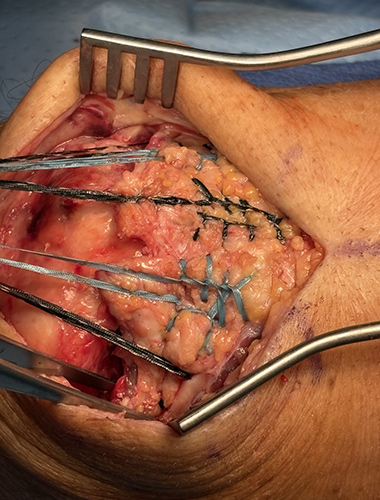 Patellar and Quad Tendon Repair
