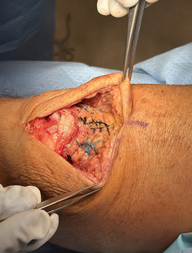 Patellar and Quad Tendon Repair