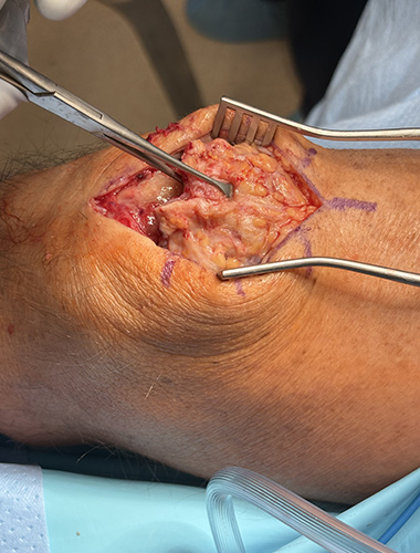 Patellar and Quad Tendon Repair
