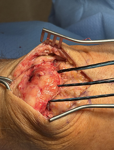 Patellar and Quad Tendon Repair
