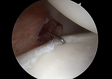 Posterior Shoulder Labral Repair