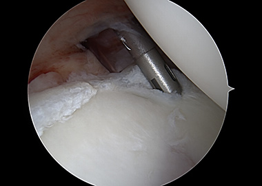 Posterior Shoulder Labral Repair
