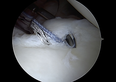 Posterior Shoulder Labral Repair