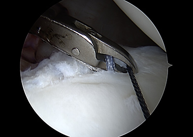 Posterior Shoulder Labral Repair