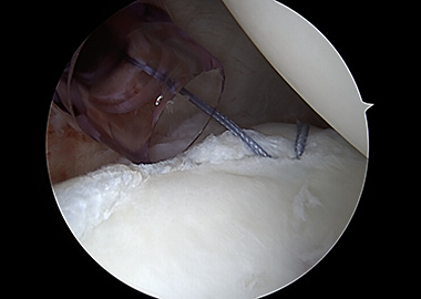 Posterior Shoulder Labral Repair