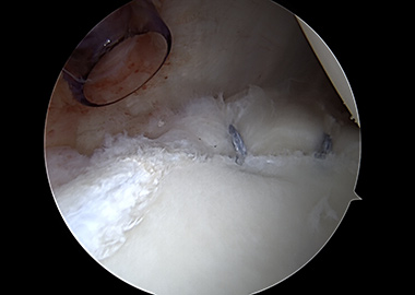 Posterior Shoulder Labral Repair